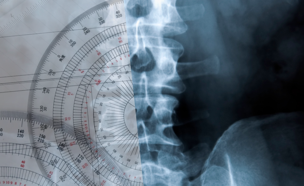 Back pain relief Ottawa – lumbar spine X-ray and posture assessment for lasting results